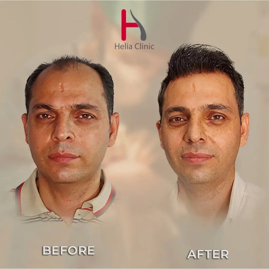 before-after-hair-transplant-user1